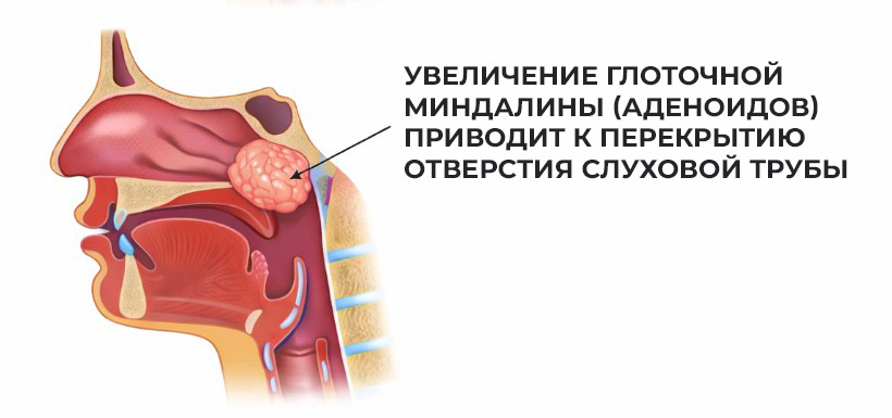 увеличенные-аденоиды-могут-перекрывать-устья-евстахиевых-труб-словно-пробки-и-провоцировать-отит увеличенные-аденоиды-могут-перекрывать-устья-слуховых-труб